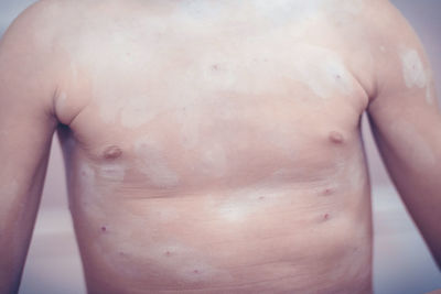 Midsection of shirtless boy with chickenpox