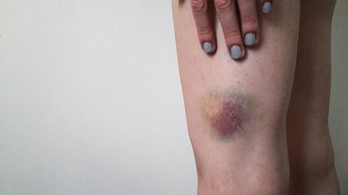 Midsection of woman with bruised leg against wall