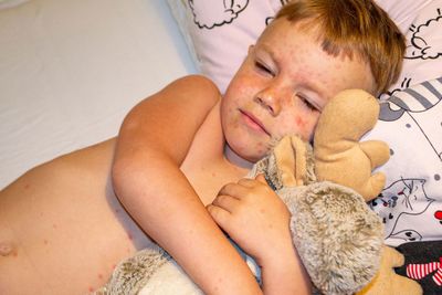 Varicella virus or chickenpox bubble rash on child