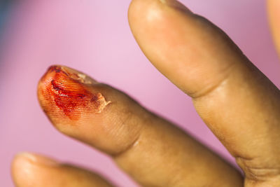 Close-up of person with wound on finger over purple background