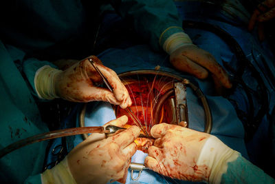 Midsection of surgeons performing surgery at operating room