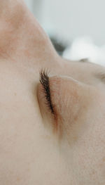 Closed and bulging eye of a woman with eyelashes.