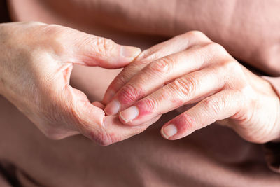 Close up of elder woman hands with atopic dermatitis, eczema, allergy reaction on dry skin