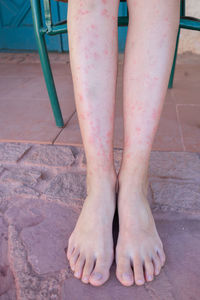 Girl's legs bitten by mosquitoes, close-up. woman scratching her feet bitten by insects.