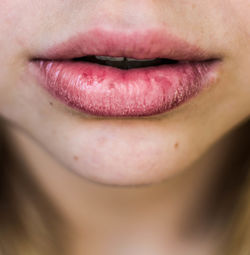Cropped image of woman with dry lips