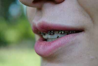 Close-up of woman with braces
