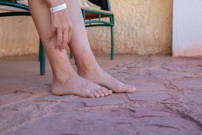 Girl's legs bitten by mosquitoes, close-up. woman scratching her feet bitten by insects.