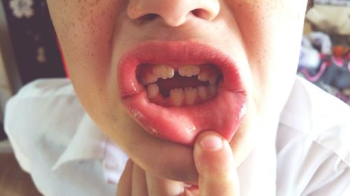 Close-up of boy with missing tooth