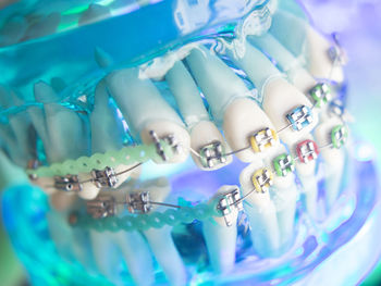 Close-up of dentures with braces