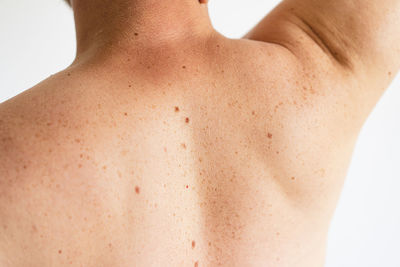 Pigmentation. close up detail of the bare skin on a man back with scattered moles and freckles.