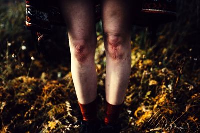 Bruised legs of woman standing on field