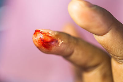 Close-up of person with wound on finger over purple background