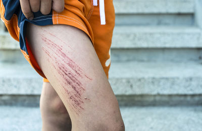 Midsection of person showing wounded thigh outdoors