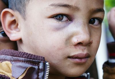 Close-up portrait of cute boy with bruise on face