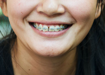 Close-up of a woman wearing braces.