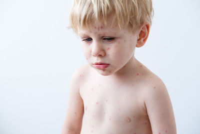 Chickenpox disease, portrait of blonde little boy with red rashes chicken pox virus