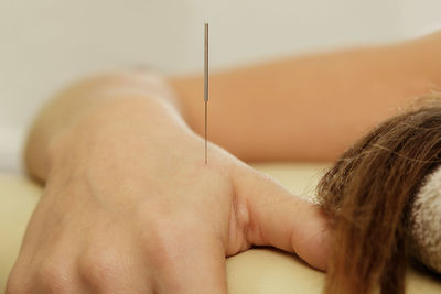 Alternative medicine. female arm with steel needles during procedure of acupuncture therapy.