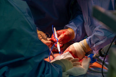 Surgical operation, closeup on operating field and hands of surgeons