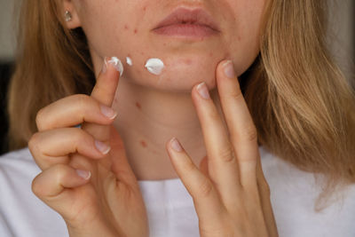 Unrecognizable woman applies makeup, cream serum cure for acne on face. close-up acne on woman's