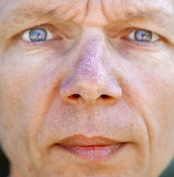 Close-up of man with skin of nose peeling off