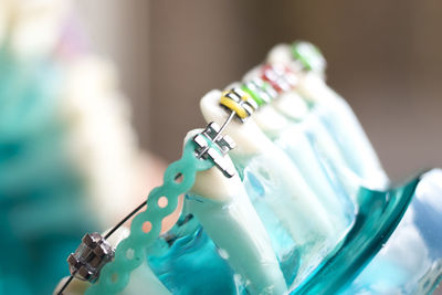 Close-up of dentures with braces