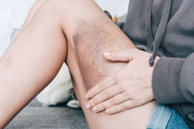 Woman is smearsing a big bruise on her leg