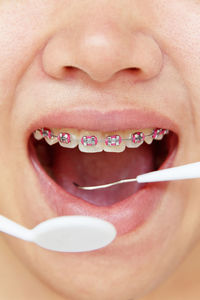 Close-up of braces on woman teeth