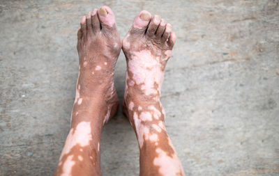 The old man's leg with a skin condition that causes loss of melanin vitiligo disorder.