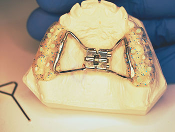 Hyrax braces wear on patient teeth gypsum model. dentist check exact setting before put on palate.