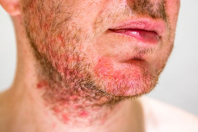 Midsection of man with beard infection against gray background