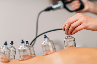 Cupping therapy, hijama. female therapist using vacuum gun for cupping therapy