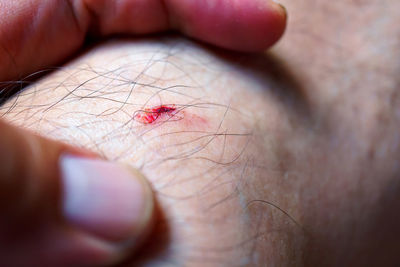 Bloody wounds, the skin is wound with blood flow, must be first aid, skin ulcers.