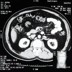 Ct scan of human abdomen