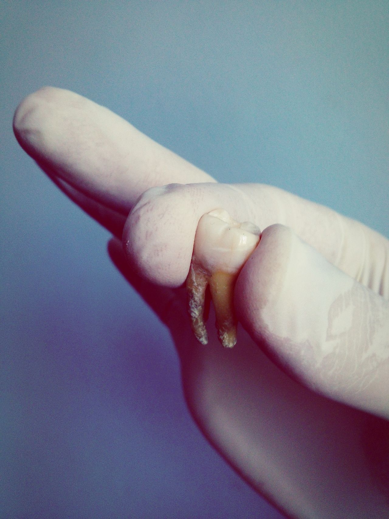 Extracted tooth