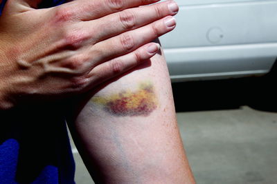 Midsection of woman with bruise on arm at footpath
