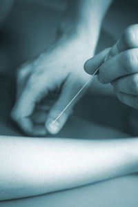 Close-up acupuncturist applying acupuncture needles on patient