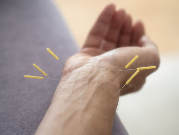 Close-up of hand with acupuncture