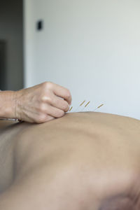 Patient having acupuncture treatment