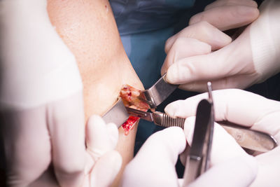 Cropped hands of surgeons doing patient surgery in hospital