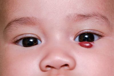 Close-up portrait of baby with mole on eye