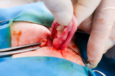 Cropped hand of doctor operating patient